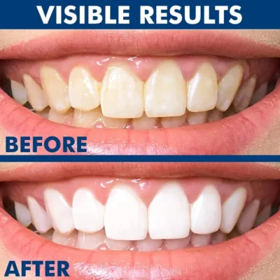 dental-teeth-whitener
